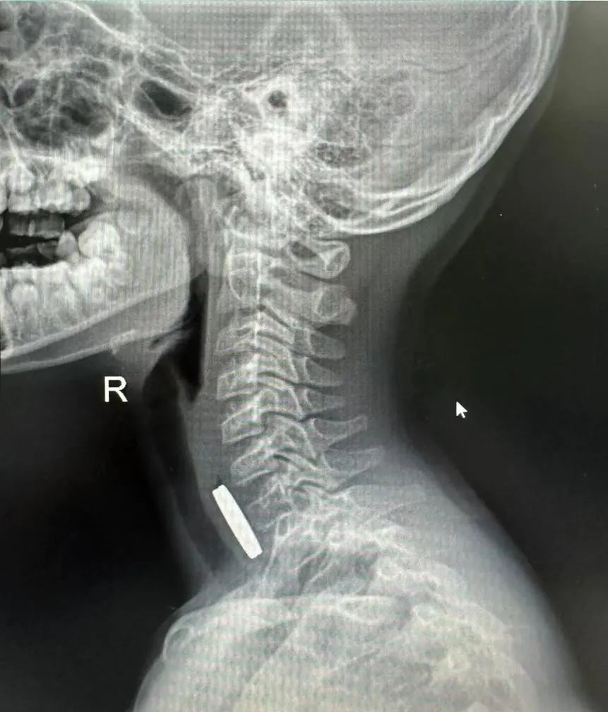 9岁男童误吞硬币卡食道！长乐医生用这个办法……